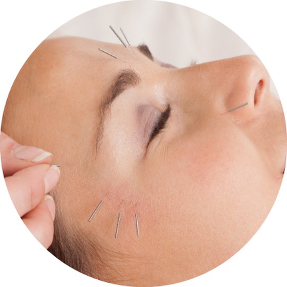 Acupuntura estética facial